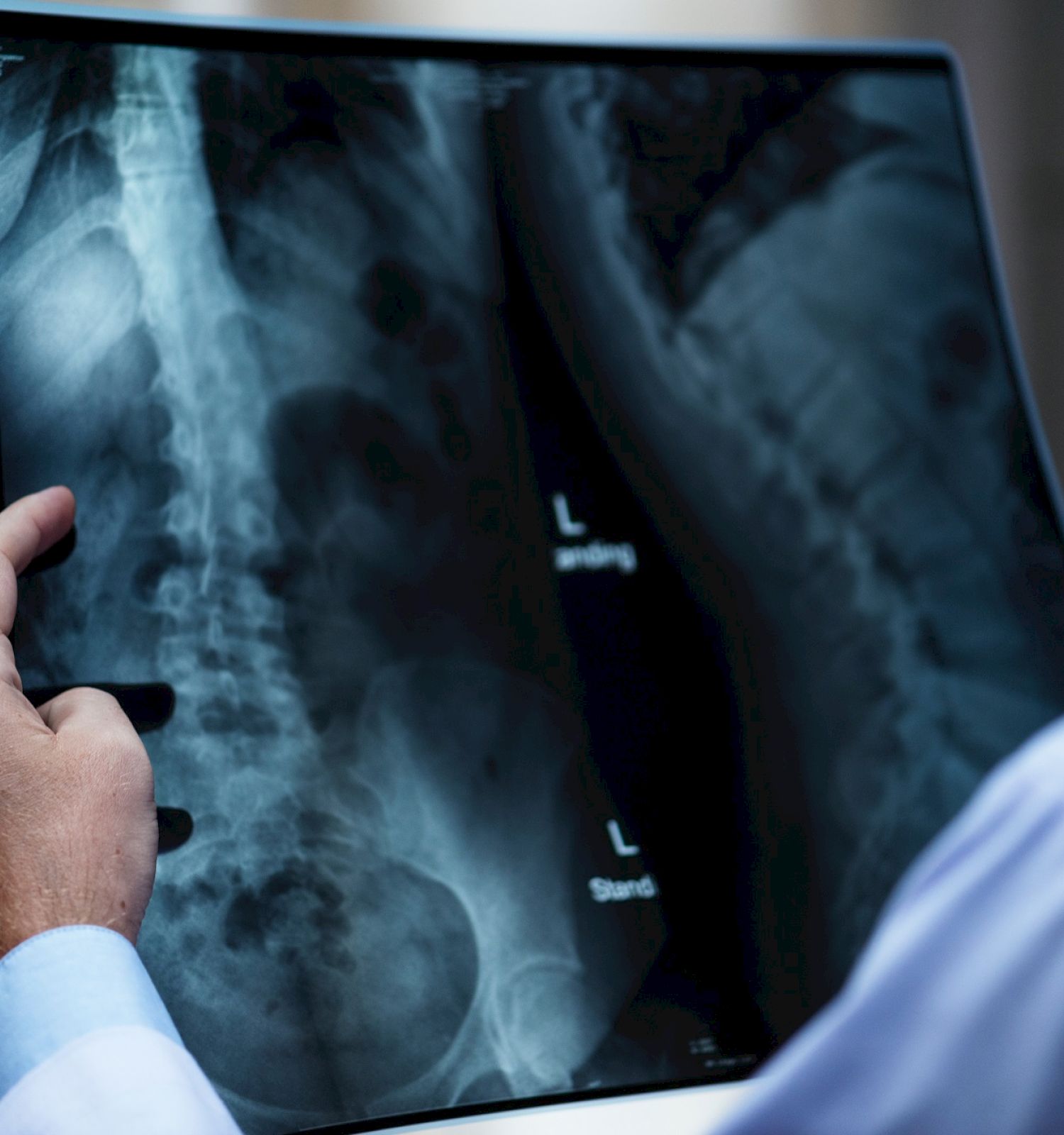 A person is holding an X-ray image displaying a spine, viewed against a light source, likely in a medical setting.